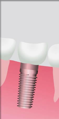 Dental Implant