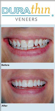 Durathin® Veneers